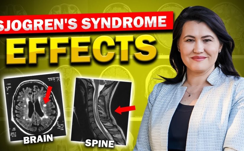 Sjogren’s Syndrome Affects the Brain and Spine